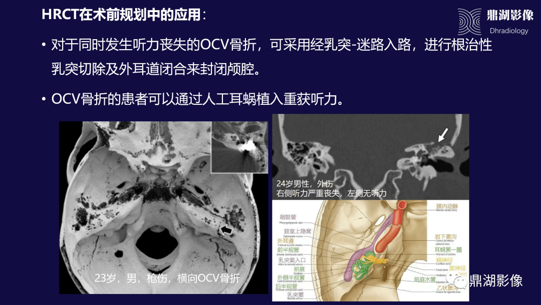 (bony) labyrinth:耳软骨囊或骨迷路是指包围内耳膜迷路的颞骨岩部的