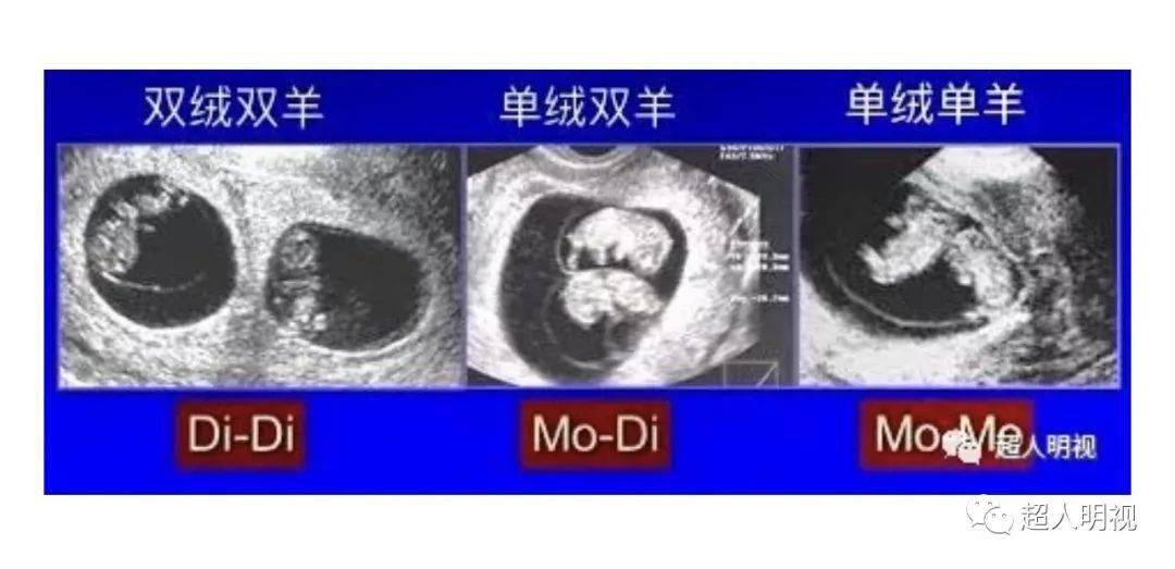 早孕时判断绒毛膜性较为简单,主要是看有几个增厚的"白圈.