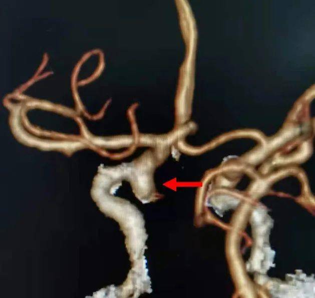 姚晓喜:支架辅助jasper03ss弹簧圈栓塞眼动脉段宽颈动脉瘤一例
