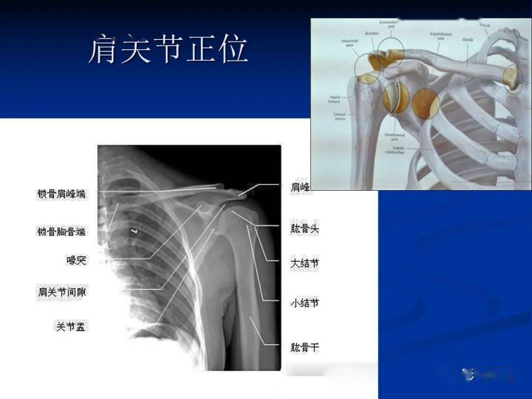 肩袖解剖及损伤的临床及mri诊断