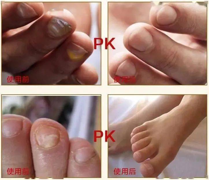 灰指甲克星来了!澳洲生物研究所研发,涂一涂无痛去灰甲