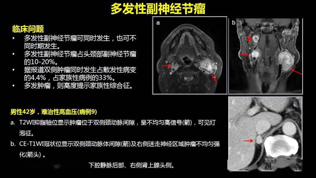 精彩推荐 | 副神经节瘤影像学:全面回顾