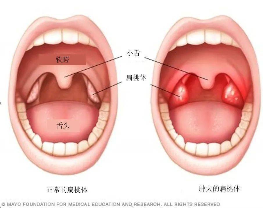 美国儿科学会研究认为,腺样体和扁桃体肿大是引起孩子原发性打鼾和