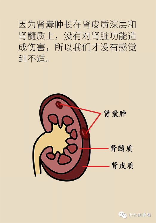 单纯性肾囊肿,要不要切了?