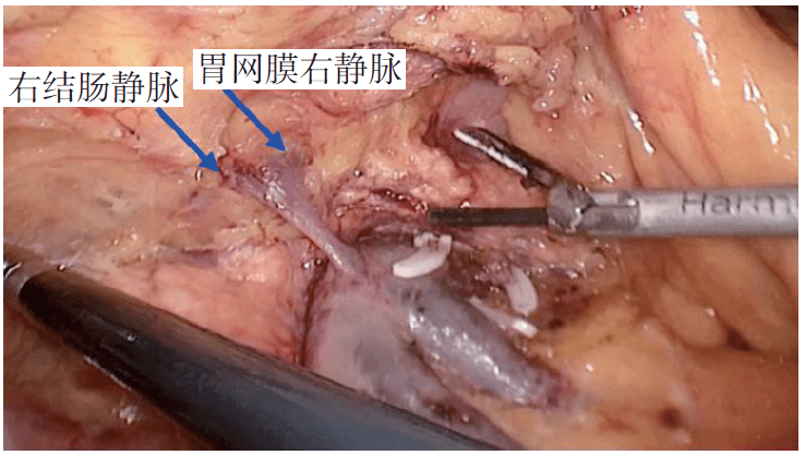 沿胰腺上缘进入胰胃间隙 (5)解剖胃结肠干及各支,保留胰十二指肠