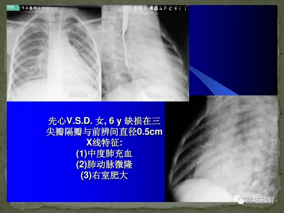 心脏和大血管病变的x线表现_肺静脉