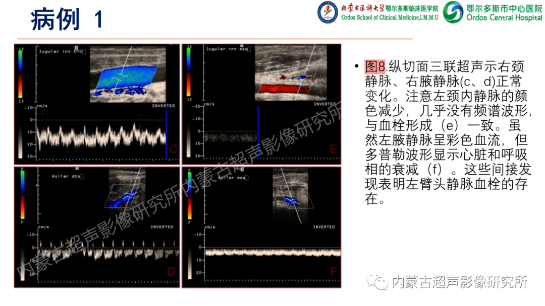 上肢深静脉血栓的超声检查.