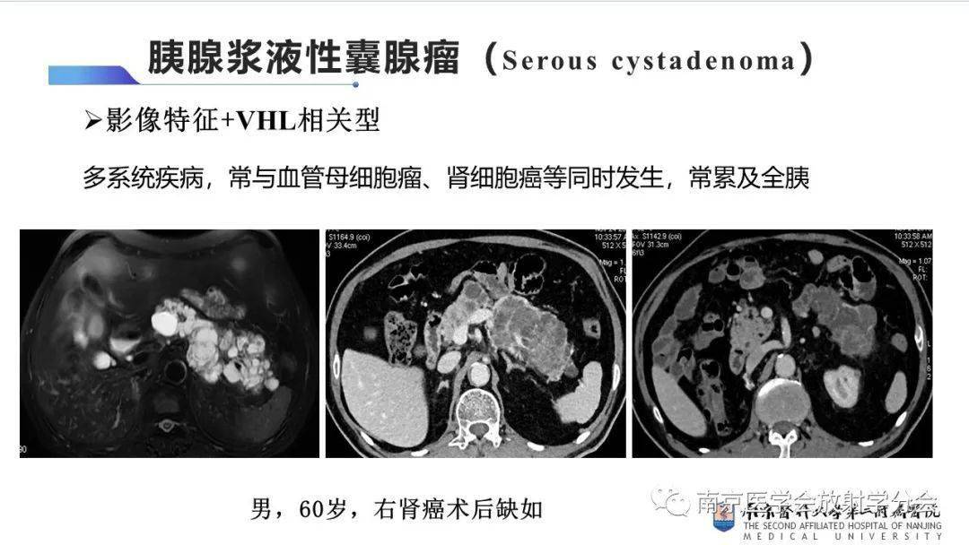 胰腺浆液腺囊腺瘤