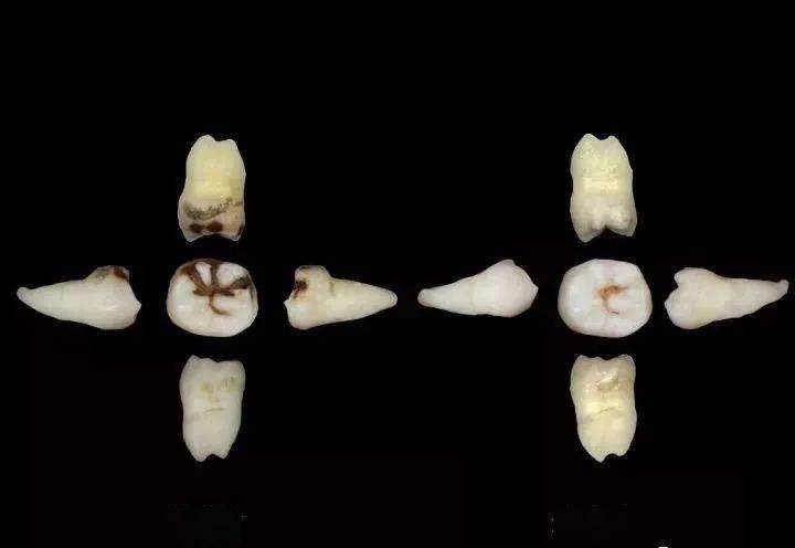 牙菌斑→牙结石→牙周炎→牙齿松动→掉牙.