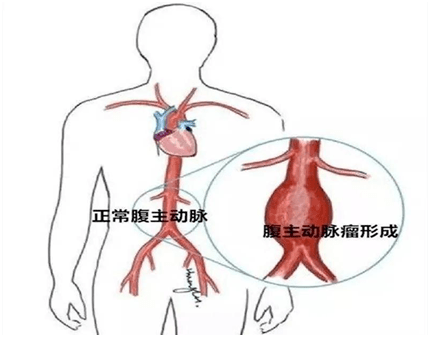 最大限度减少溶栓剂量及溶栓时间,降低出血风险及深静脉血栓后综合征