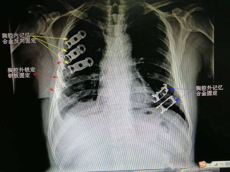 医疗动态|我院胸外科完成一例双侧肋骨骨折复合固定手术