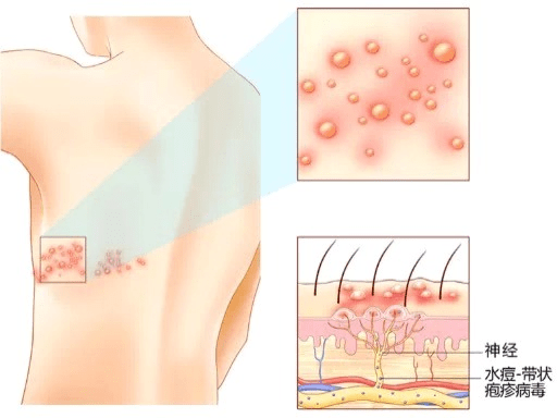 痛到怀疑人生的带状疱疹蛇缠腰有疫苗建议50岁以上接种