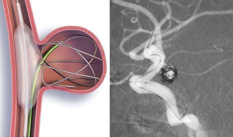 颅内动脉瘤栓塞时弹簧圈的选择