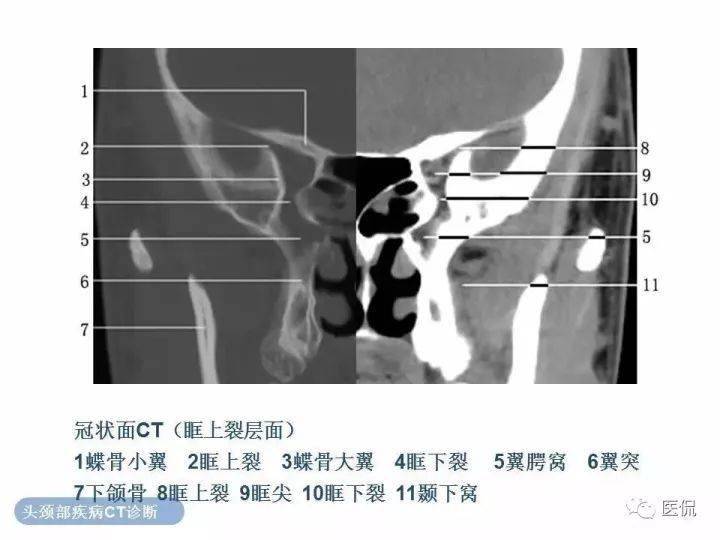 正常眼眶的ct解剖_微信