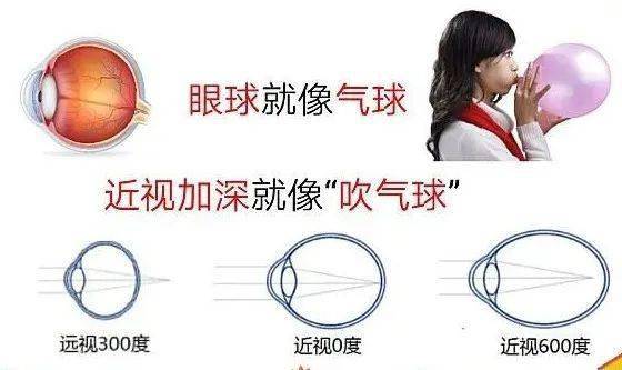 近视根本没有真假,所谓"假性近视"是由于长时间用眼过度,眼睛疲劳导致
