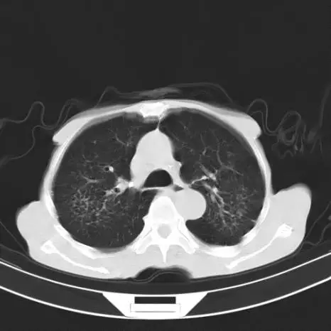 收藏十二个病人的肺ct图像详细解读