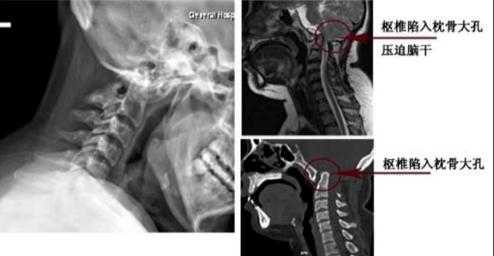 颈椎的畸形,如椎体融合,脊柱侧弯,颅底凹陷.