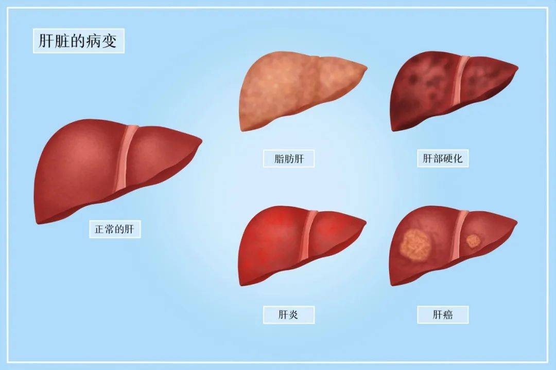 非酒精性肝硬化(肝纤维化).