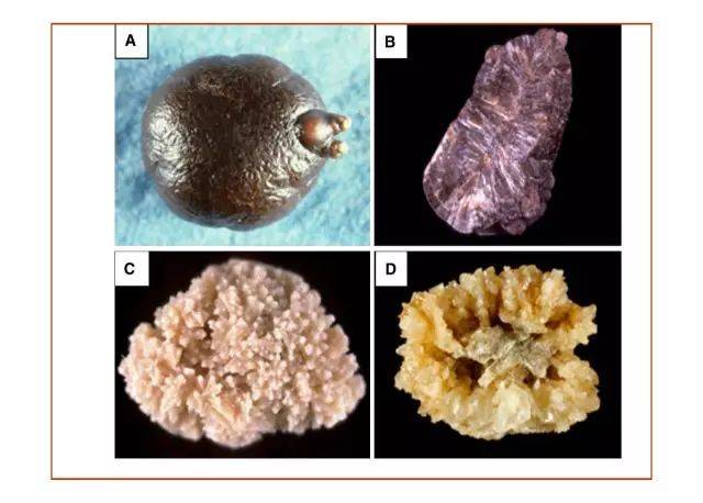 图5,常见的草酸钙结石.