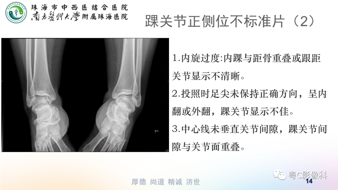 踝关节dr摄影技术分享