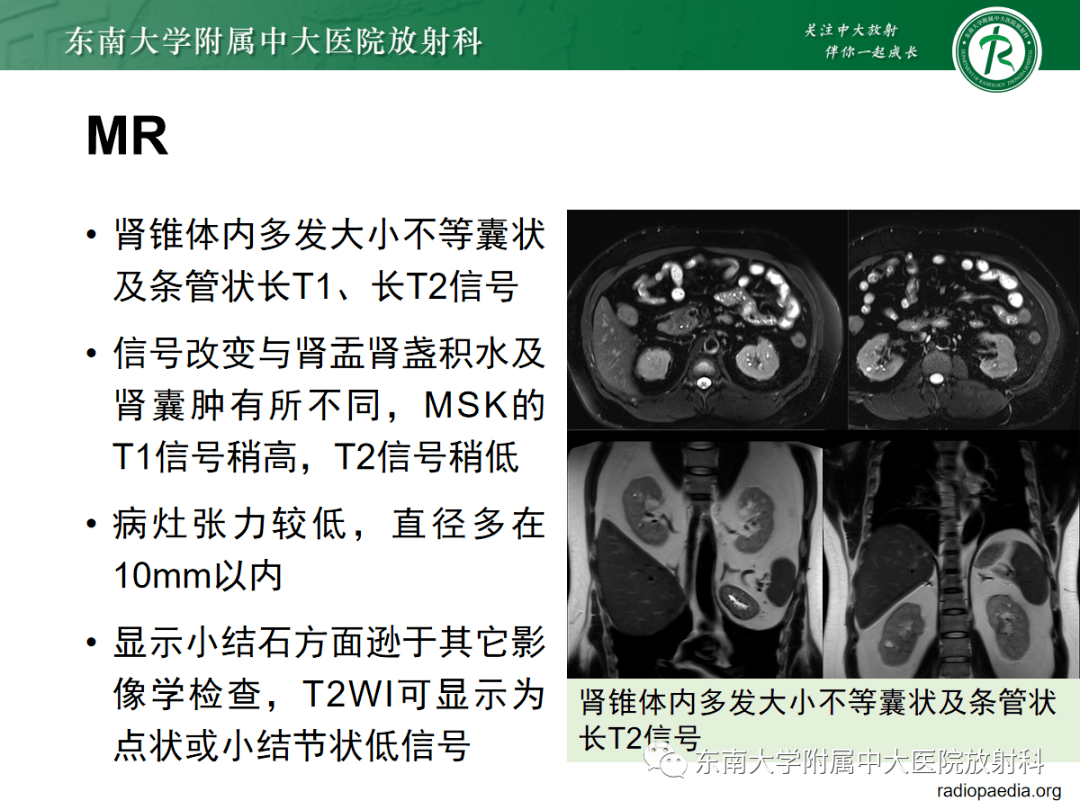 髓质海绵肾影像表现