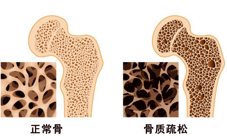 中老年人缺钙,骨质疏松在我国是一种普遍现象,腰酸背痛,弯腰驼背成为