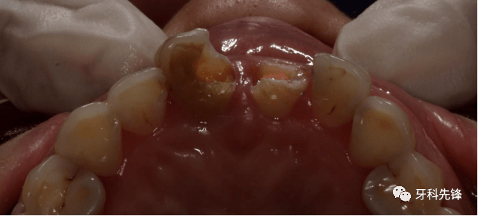 【病例】用全瓷单冠不拔牙修复前牙牙体龋坏_牙齿