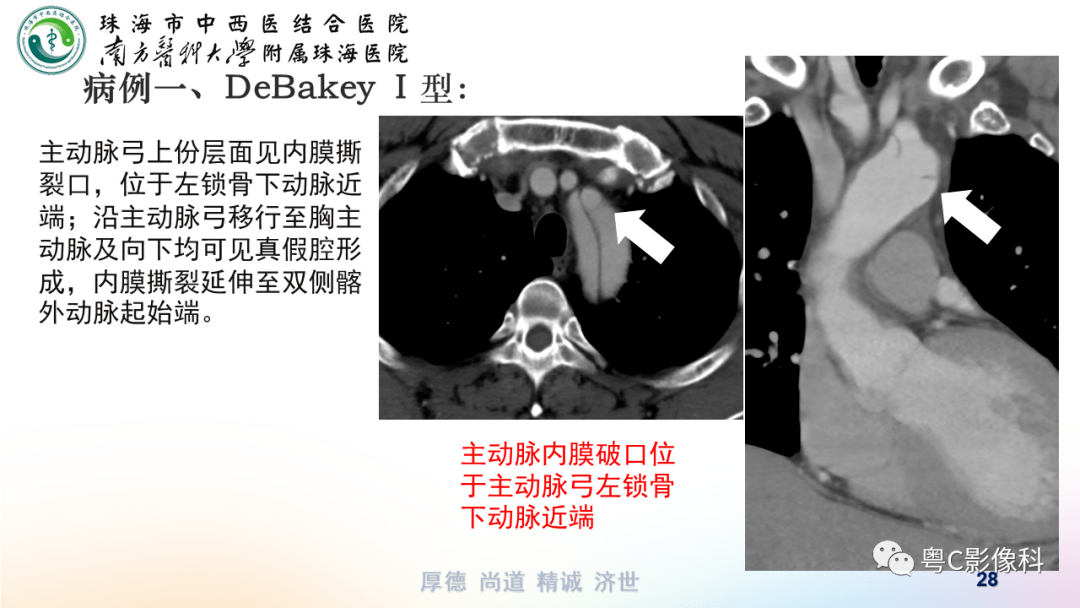 主动脉全程cta解剖及常见病变