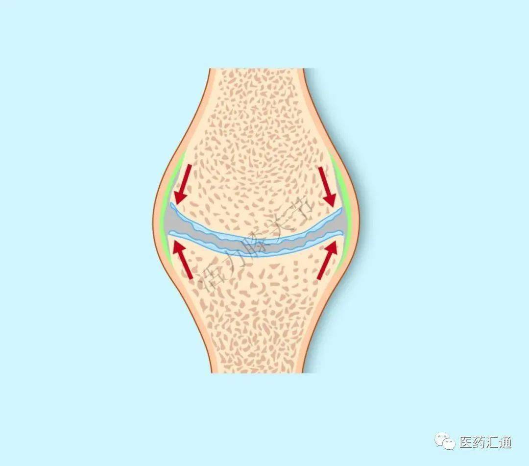 软骨的磨损会导致软骨层逐渐变得薄而粗糙.