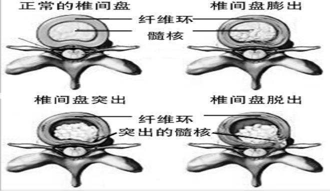 腰椎间盘突出可以用手摸出来吗?_病症_软组织_突出的