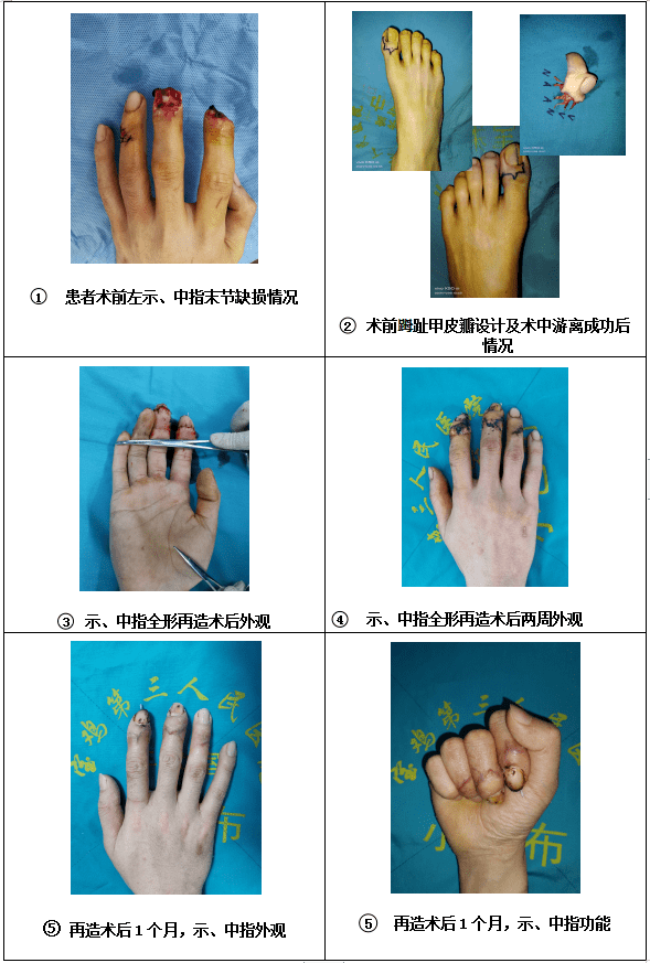 我院完成首例手指Ⅰ-Ⅱ度缺损全形再造手术_张洁_功能_刘林峰