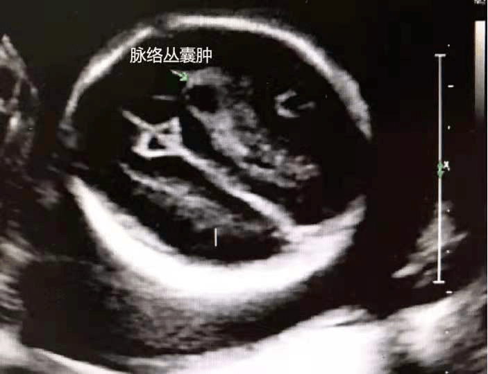 脉络丛囊肿在18三体的胎儿发生率为50%,单纯脉络丛囊肿中染色体异常的