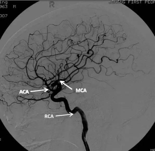 大脑前动脉分段图解_供应_交通_分支