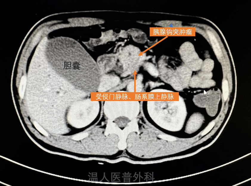 查上腹部增强磁共振发现"胰腺钩突占位伴胆管系统及胰管扩张,考虑恶性