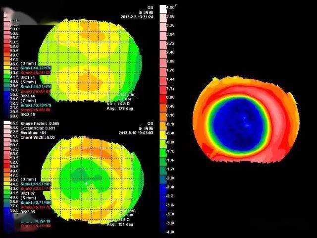 角膜塑形镜针对角膜散案例10副地形图_姜林_眼镜_中国