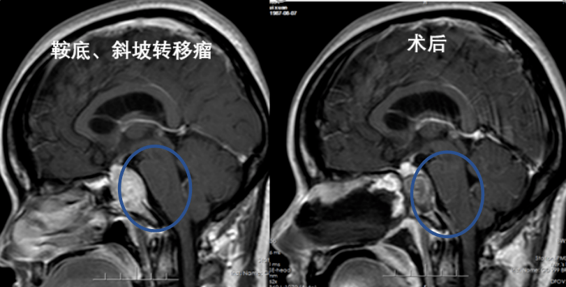 由于斜坡肿瘤主要发生于中线部位,开颅手术常常难以达到全切.