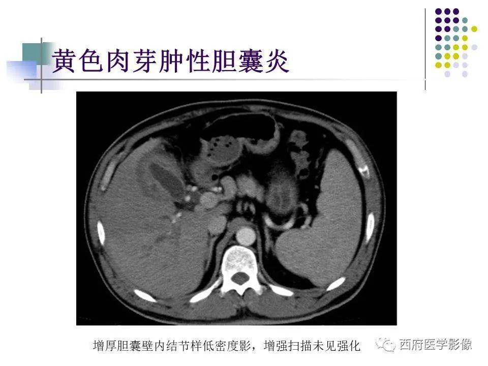 黄色肉芽肿性胆囊炎_解剖图_全网_影像