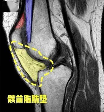 诊断髌前脂肪垫的一个小窍门.