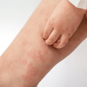 发病时间荨麻疹荨麻疹属于急发性发病,一般是在接触过敏源后,皮肤立即