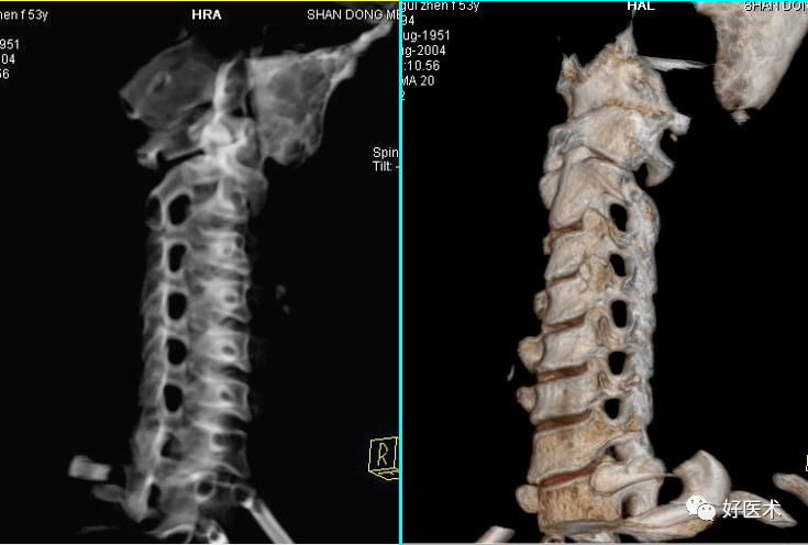 多排ct图像重建显示椎间孔因钩椎关节和上下关节突最容易增生,所以