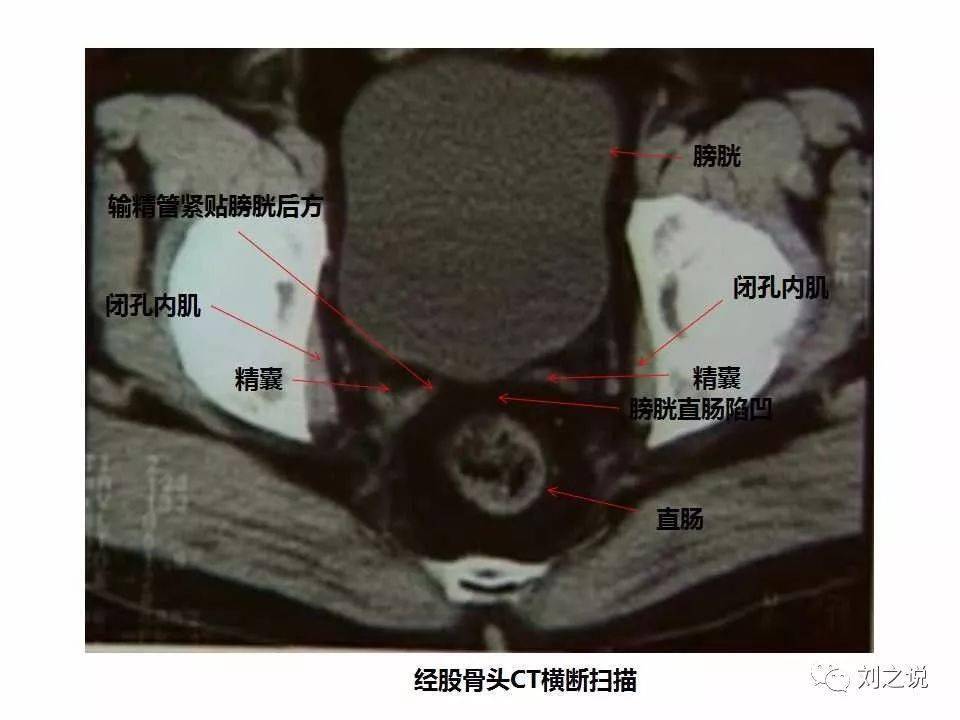 收藏必备男性盆腔断层解剖