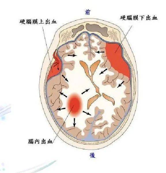 血肿_症状_医生