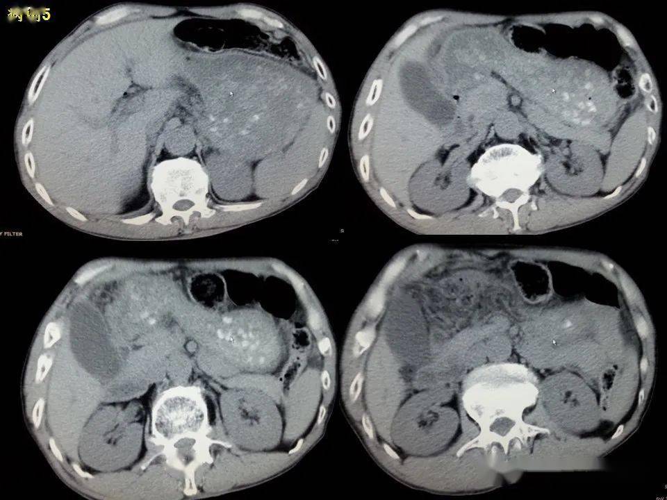 消化道穿孔ct影像大汇总看完印象深刻