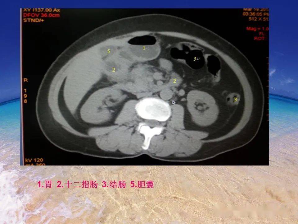 消化道穿孔ct影像大汇总看完印象深刻