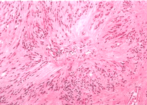 新版who室管膜瘤(ependymoma)诊断要点_细胞_病理_血管