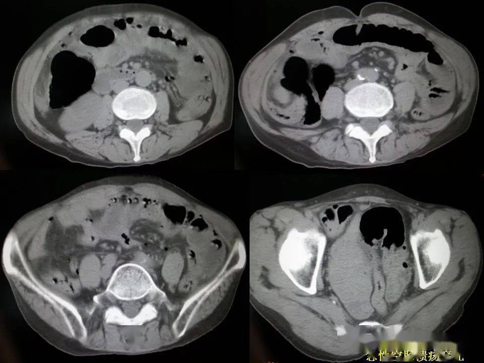 消化道穿孔ct影像大汇总看完印象深刻