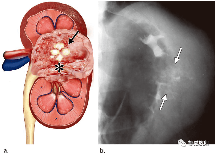 肾盂肾盏尿路上皮癌丨不常见影像表现