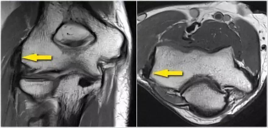 收藏肘关节常见病的mri图谱大汇总