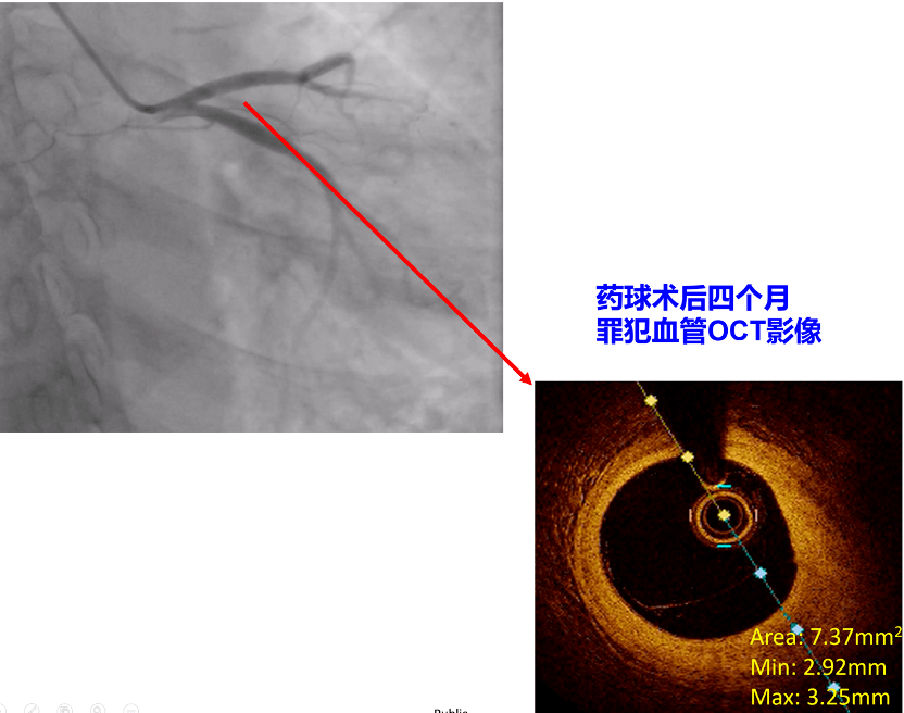 风险管理丨黄兵:pcsk9抑制剂促进acs患者ptca术后破裂斑块修复_mmol