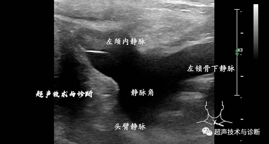 超声显示颈内静脉及锁骨下静脉汇入头臂静脉处超声显示颈外静脉及其